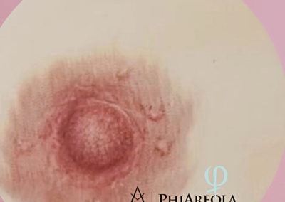 Areola-Rekonstruktion: Ergebnis einer Pigmentierung
