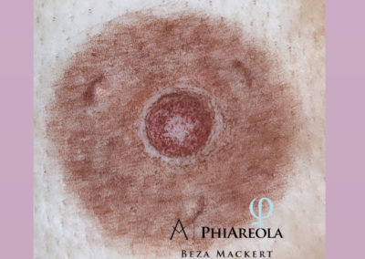 Areola-Rekonstruktion: Ergebnis einer Pigmentierung